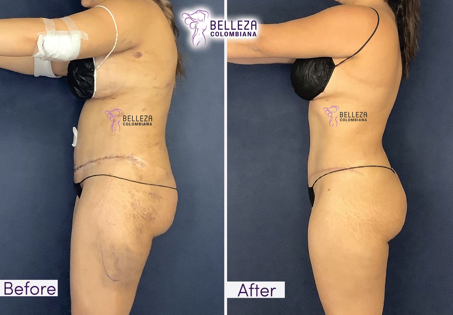 Post Op Before & After