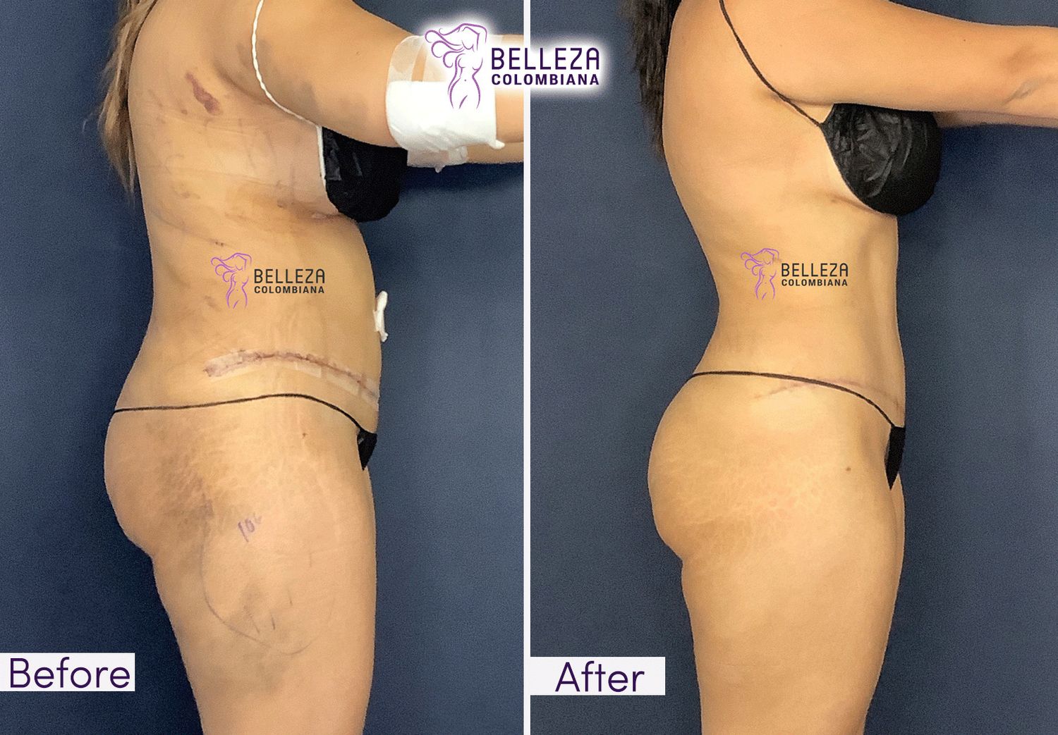 Post Op Before & After