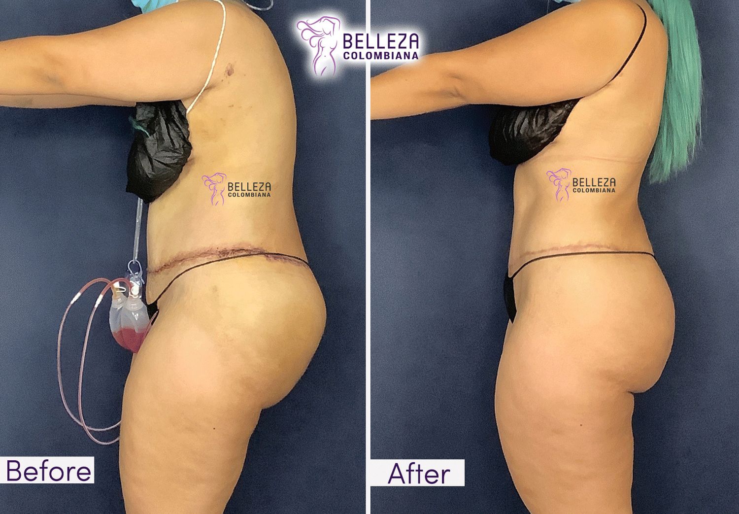 Post Op Before & After