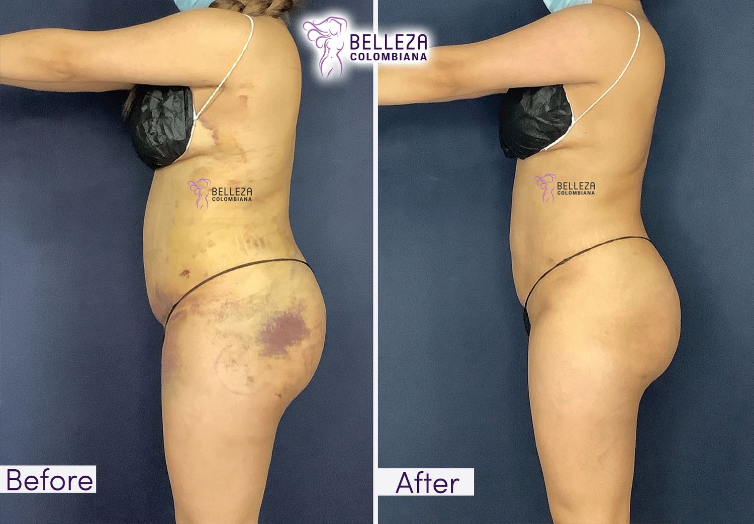 Post Op Before & After