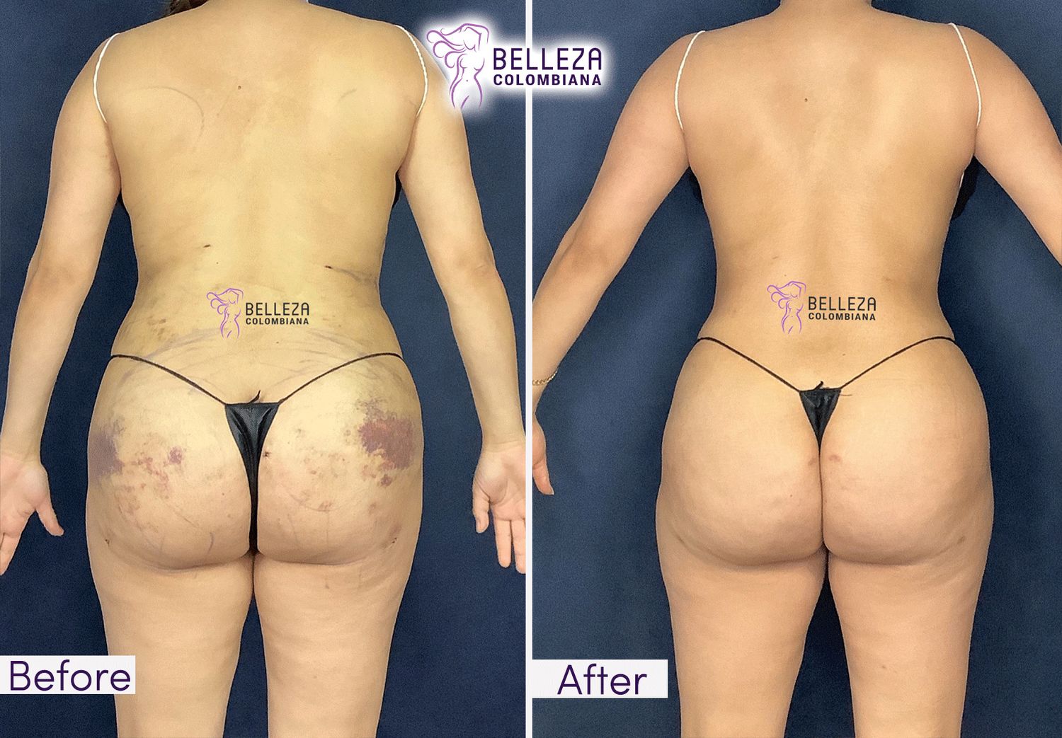 Post Op Before & After