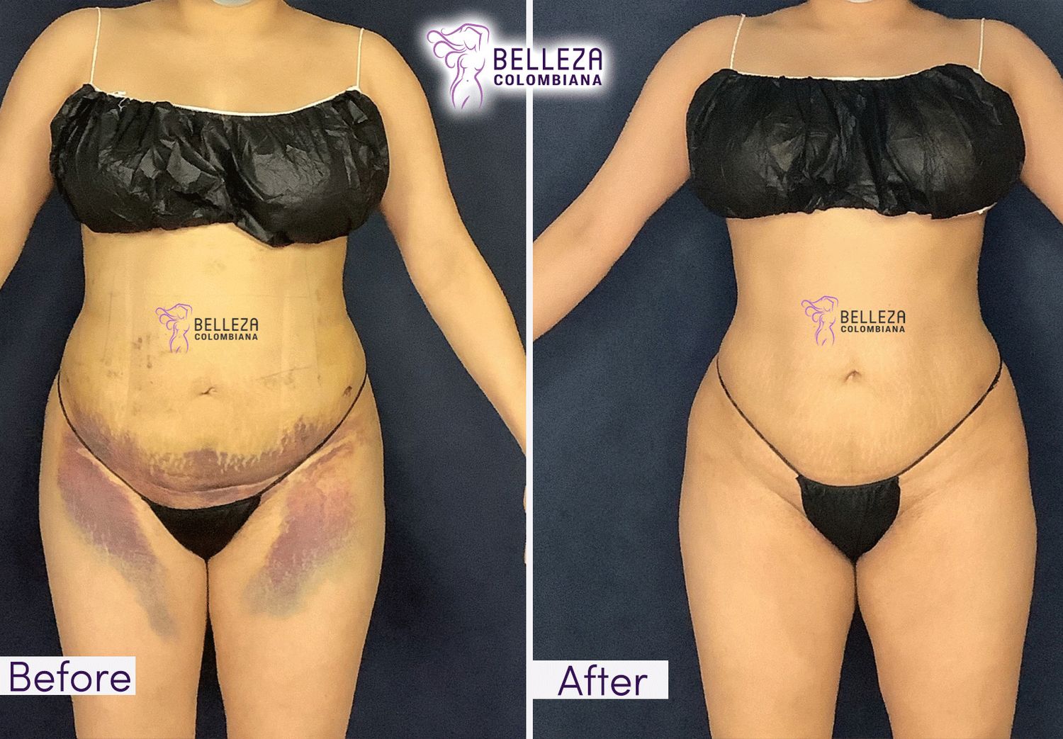 Post Op Before & After