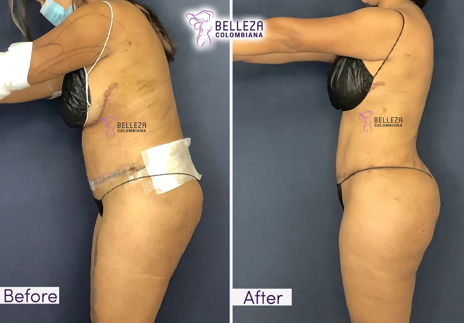 Post Op Before & After