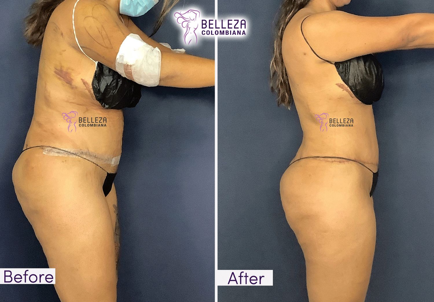 Post Op Before & After