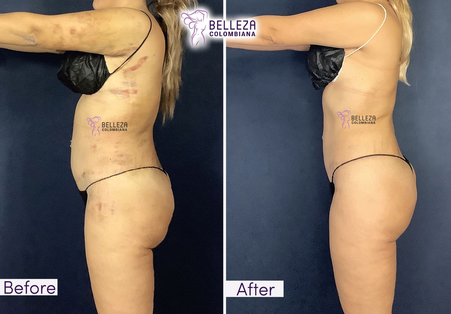 Post Op Before & After