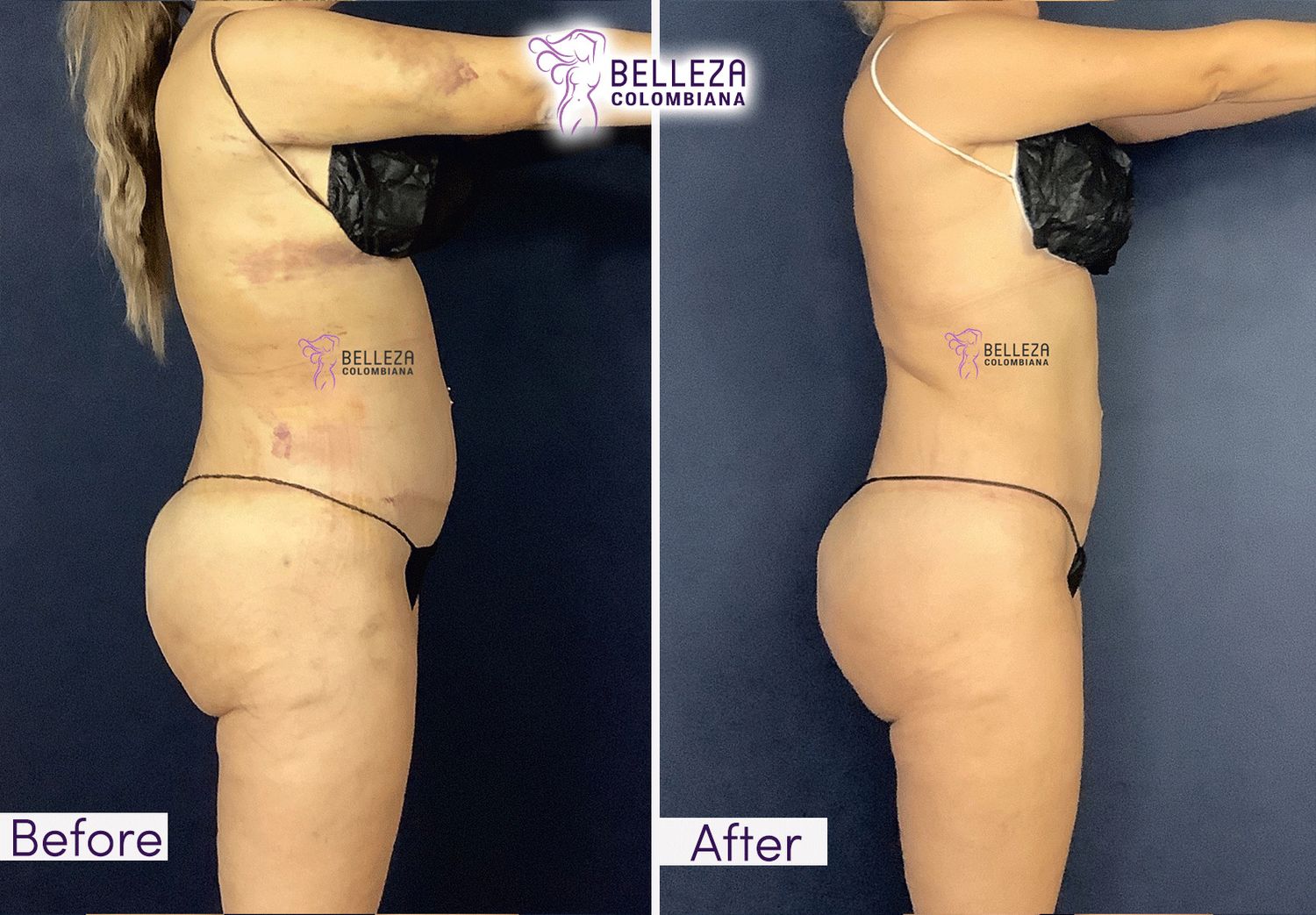 Post Op Before & After