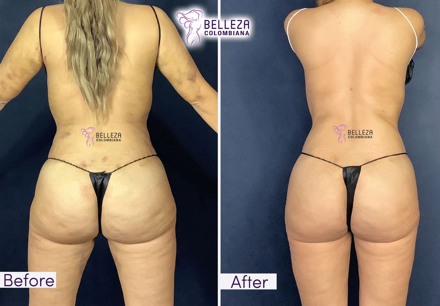 Post Op Before & After