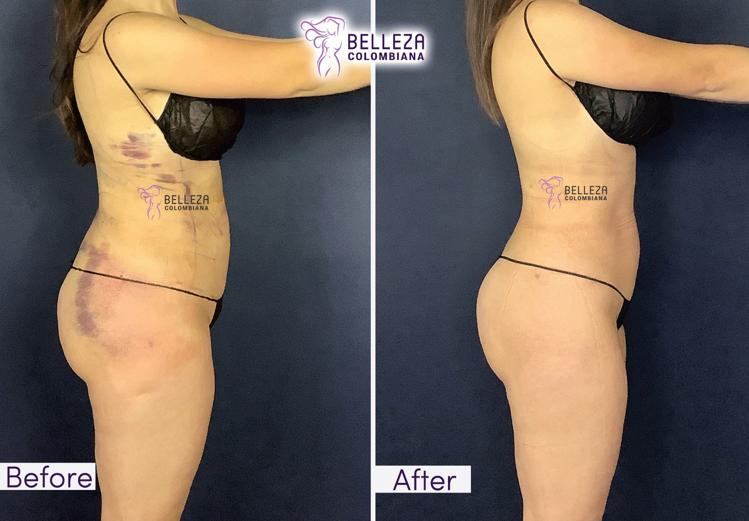 Post Op Before & After