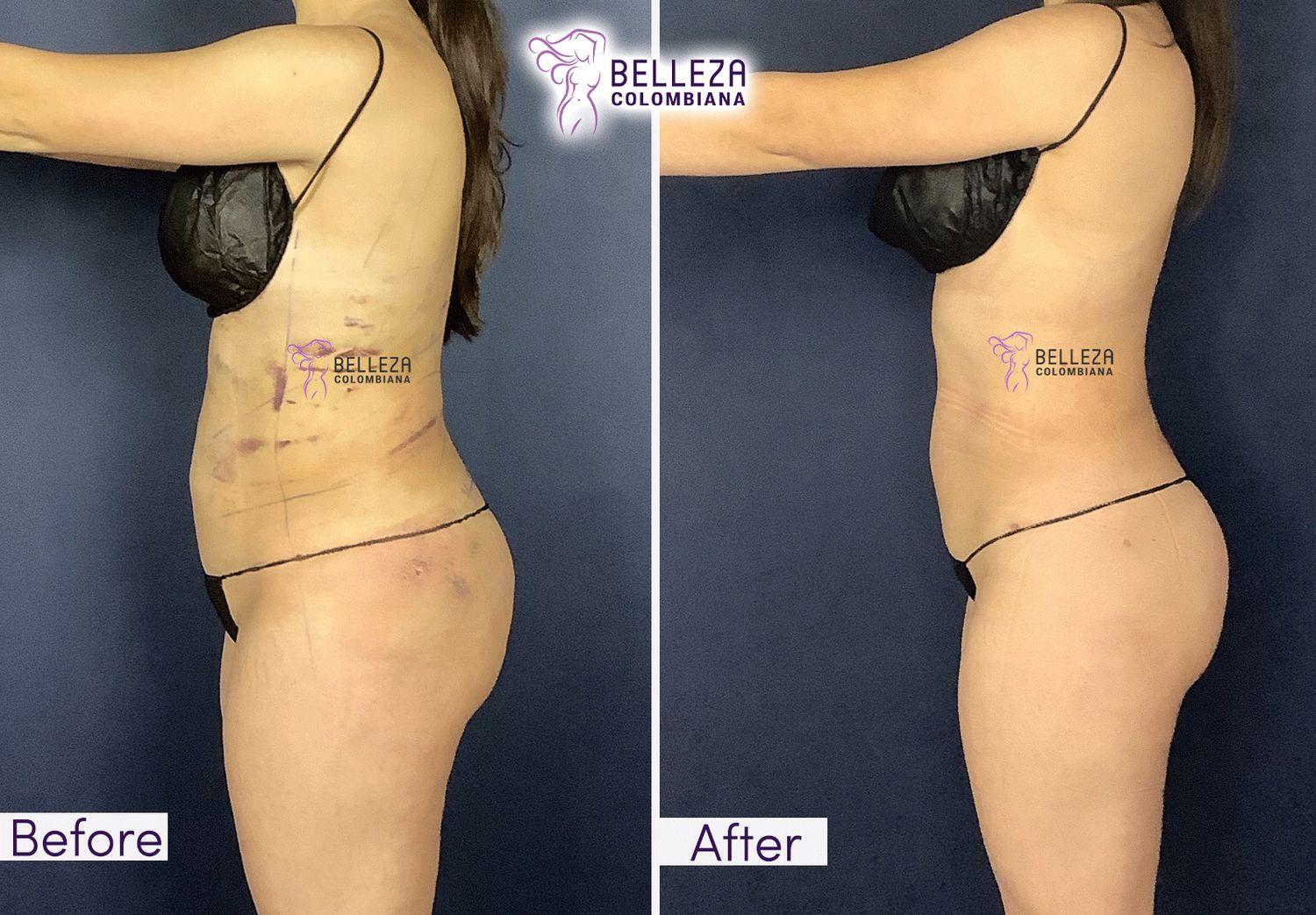 Post Op Before & After