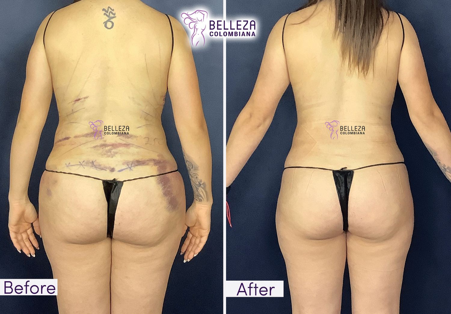 Post Op Before & After