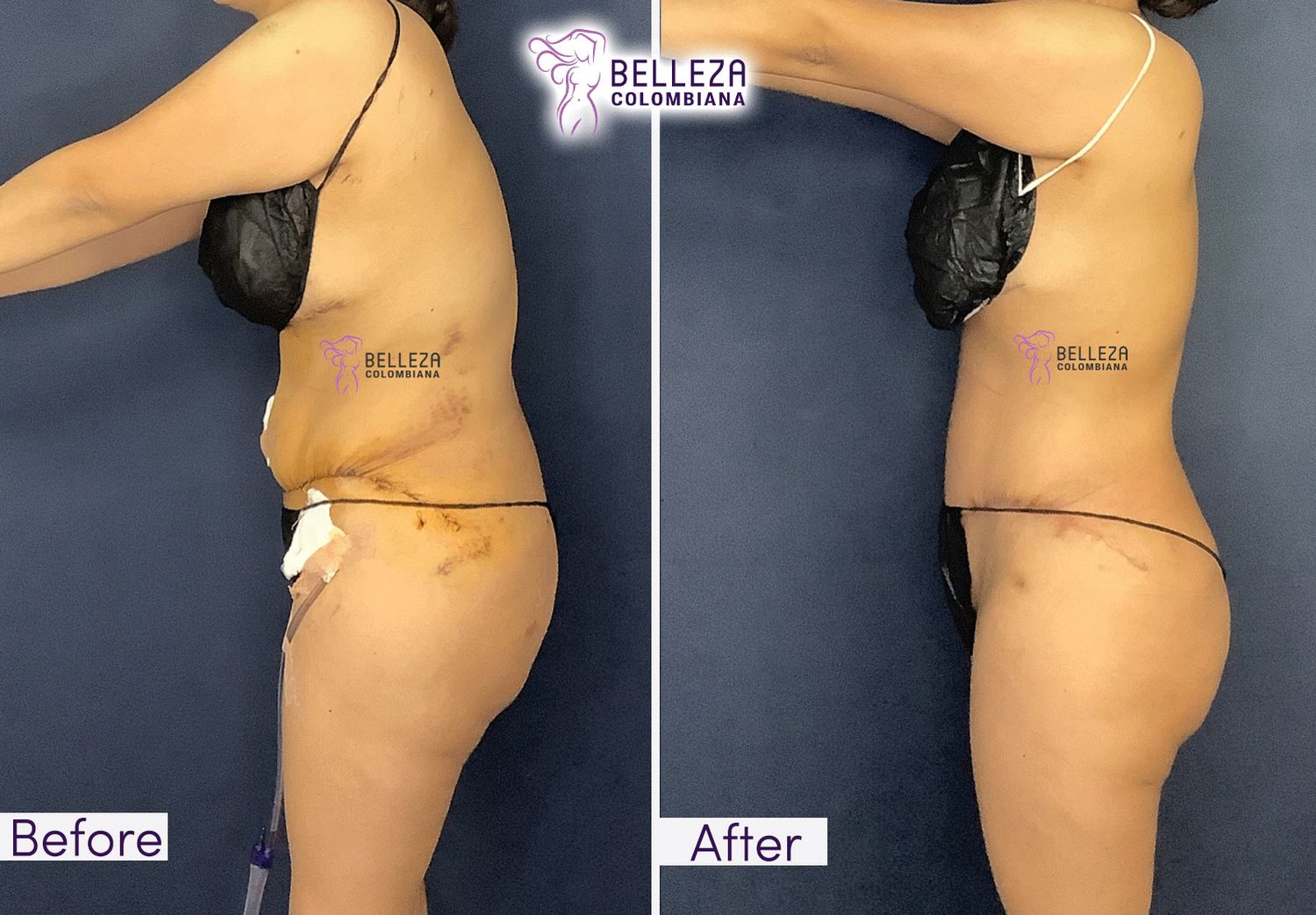 Post Op Before & After