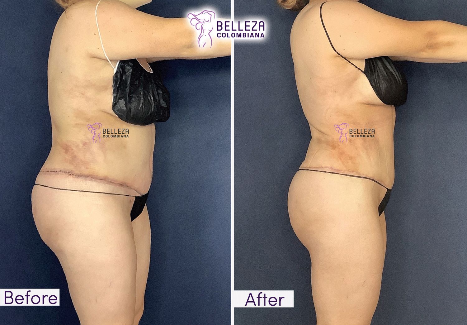 Post Op Before & After