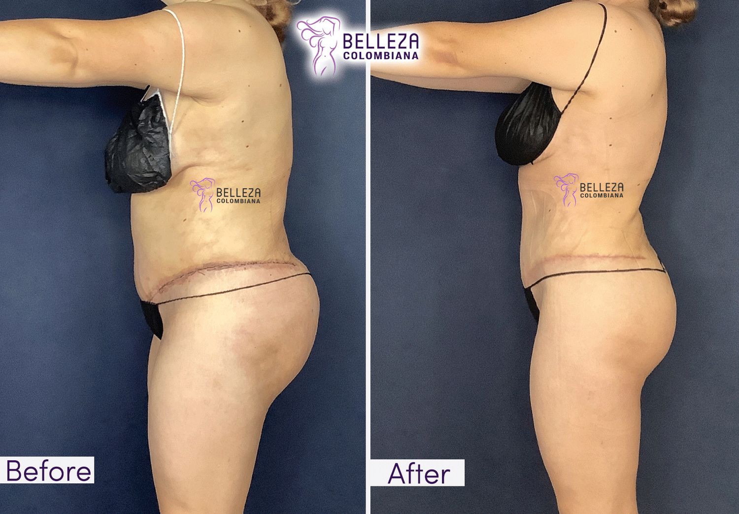 Post Op Before & After