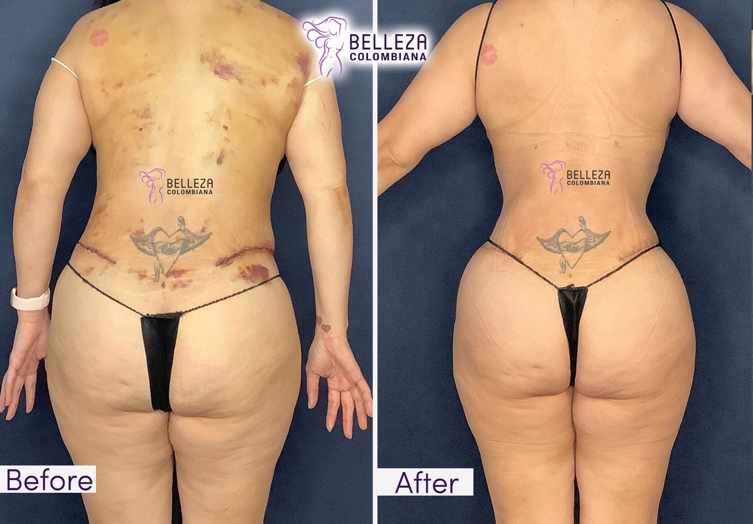 Post Op Before & After