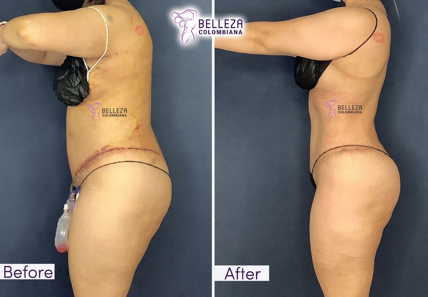 Post Op Before & After