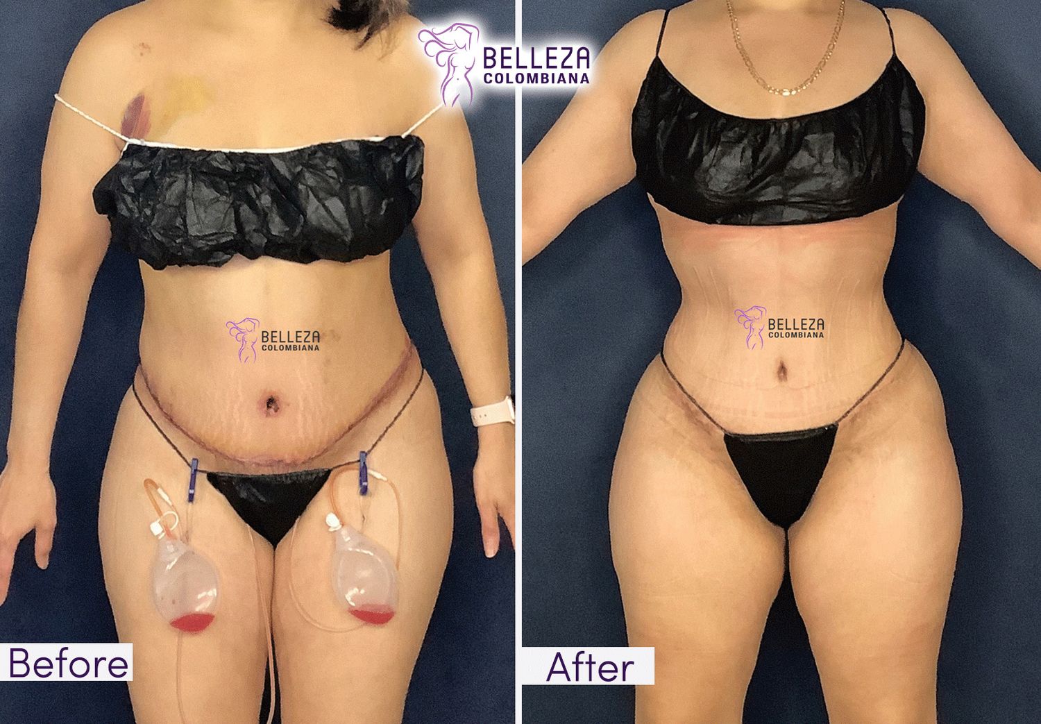 Post Op Before & After