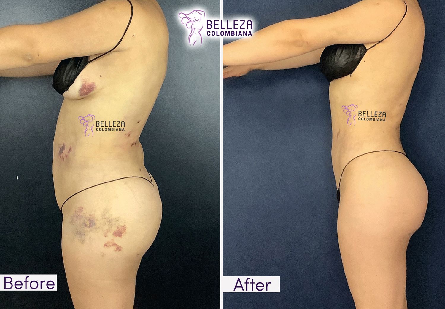 Post Op Before & After