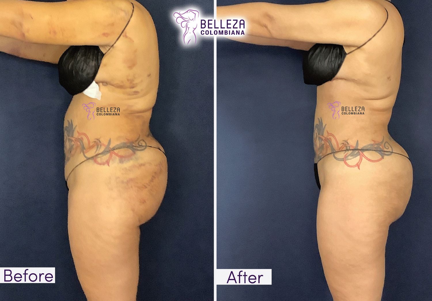 Post Op Before & After