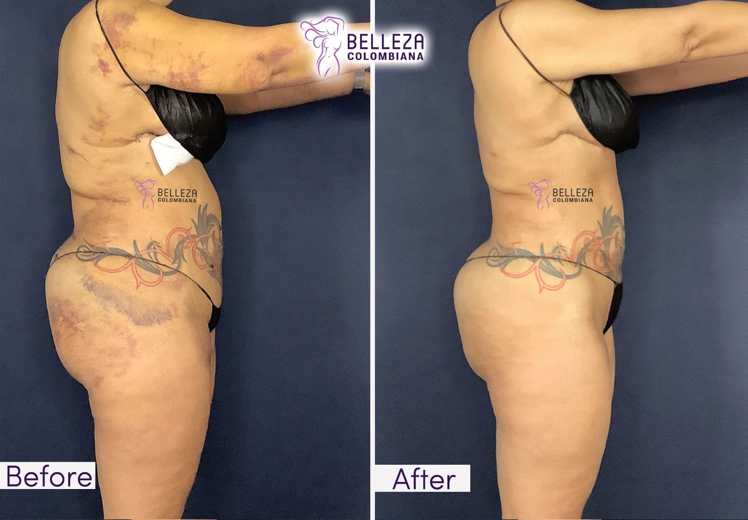 Post Op Before & After