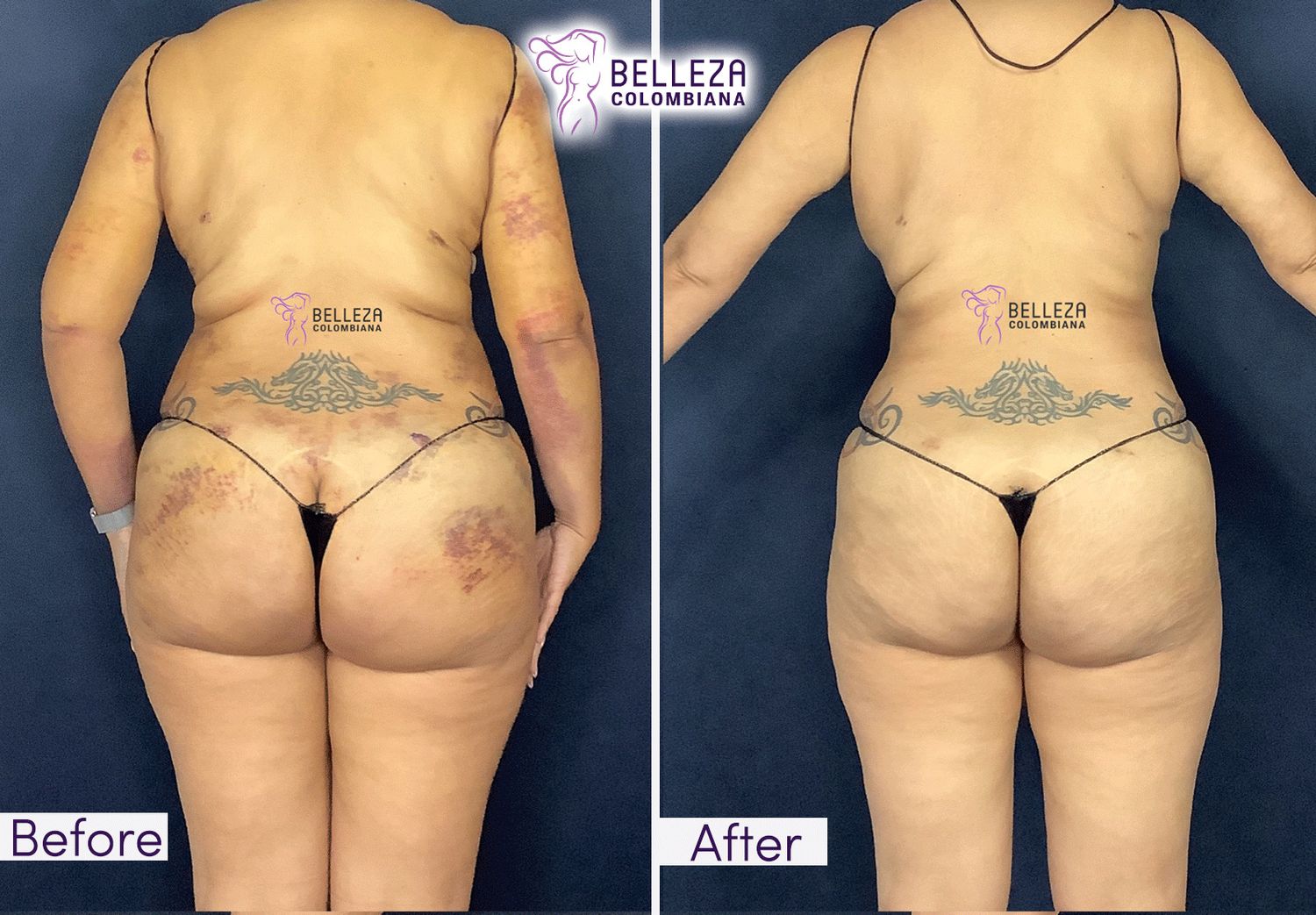 Post Op Before & After