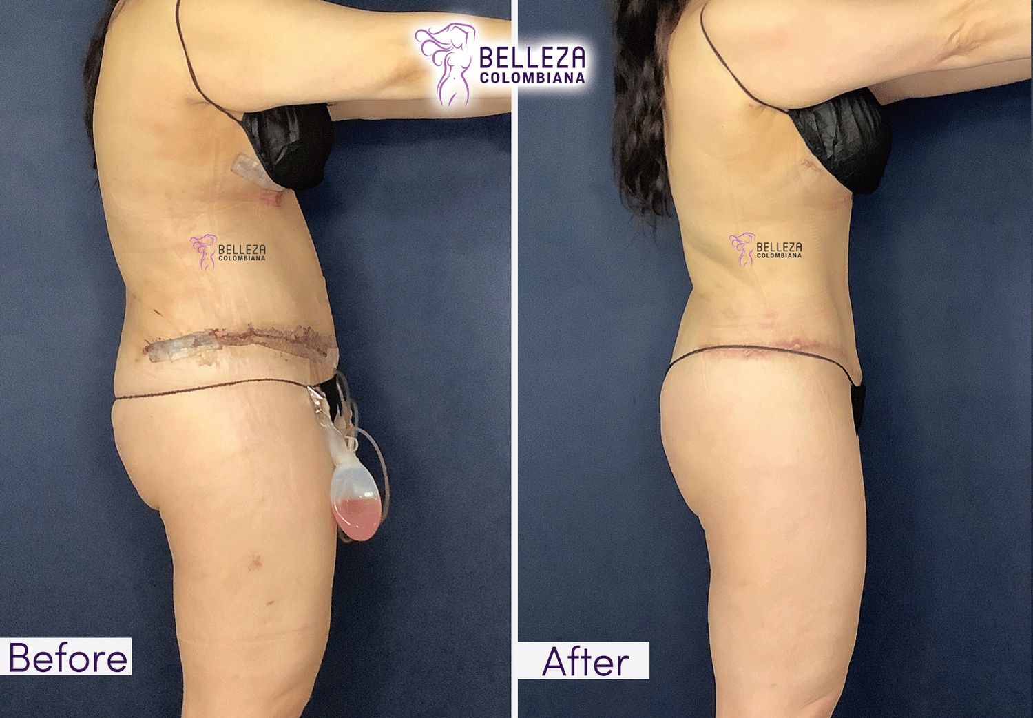 Post Op Before & After