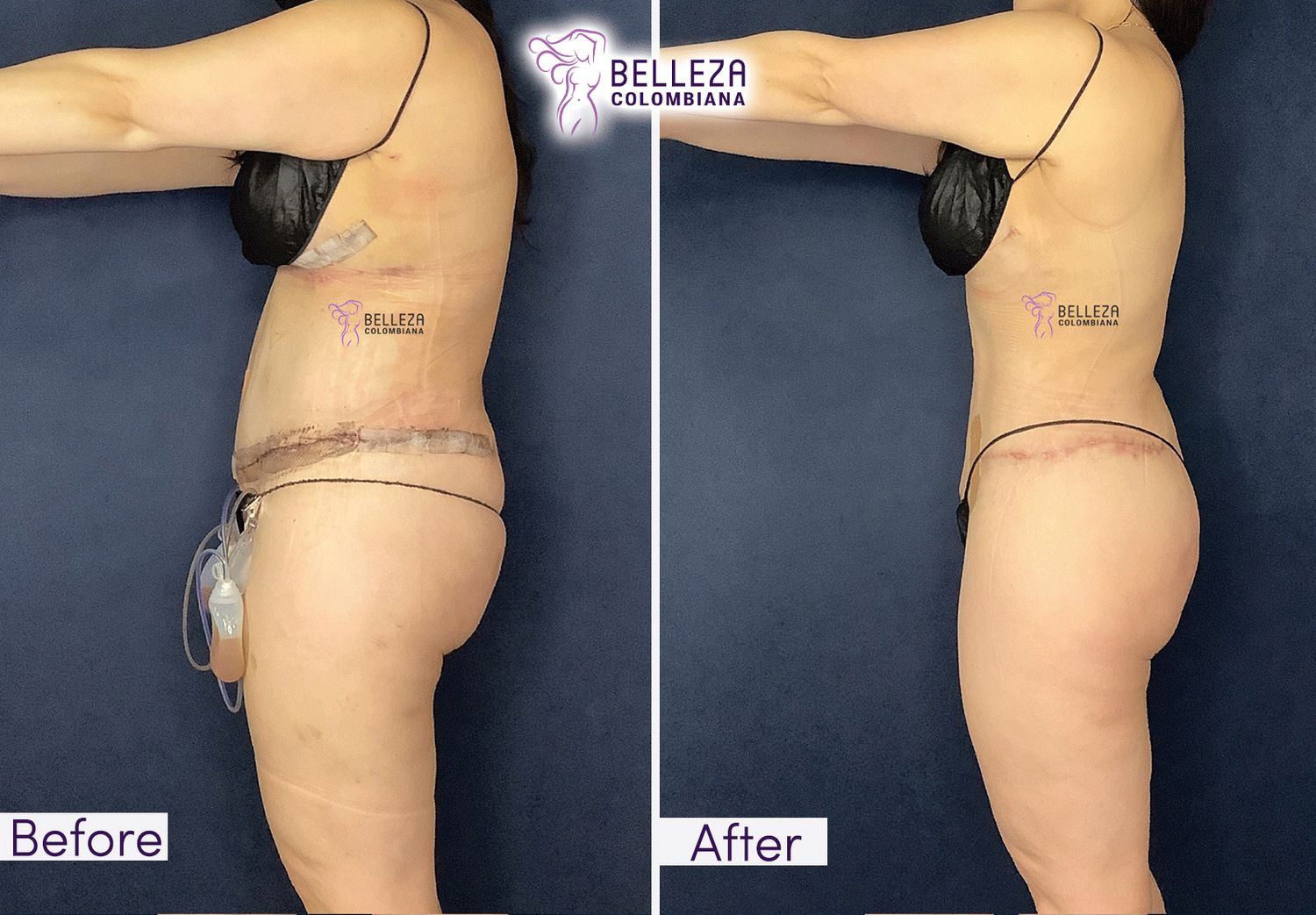 Post Op Before & After