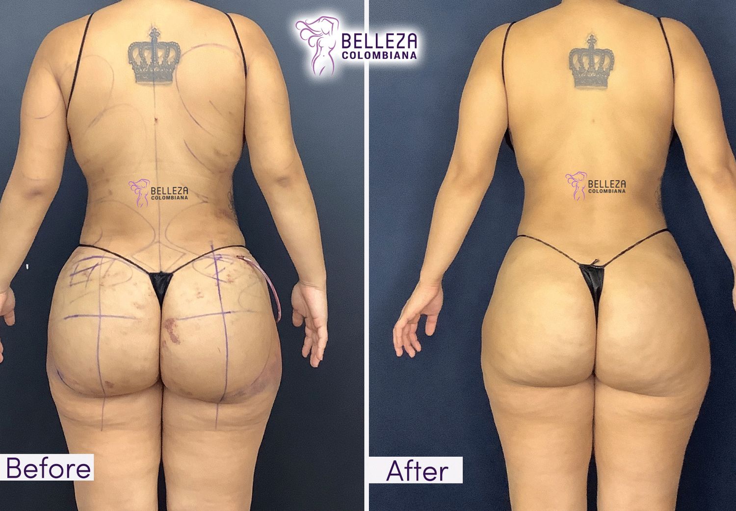 Post Op Before & After