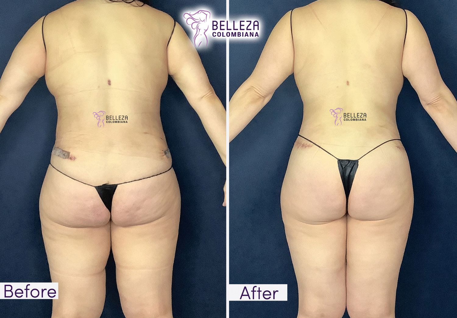 Post Op Before & After