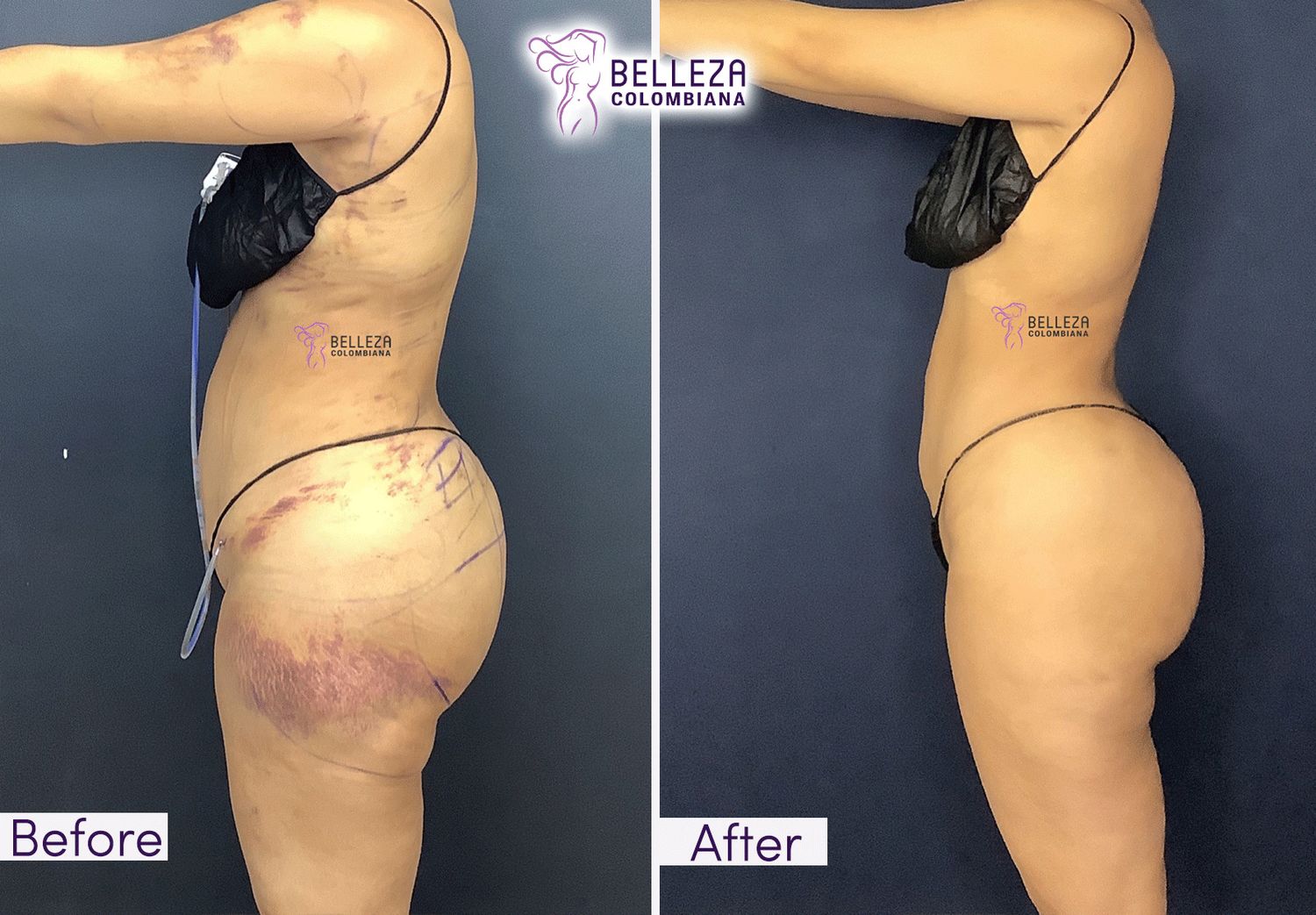 Post Op Before & After