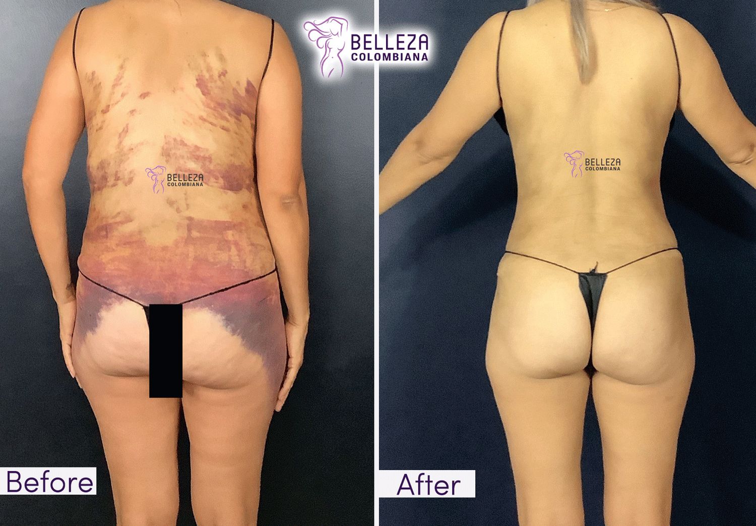 Post Op Before & After