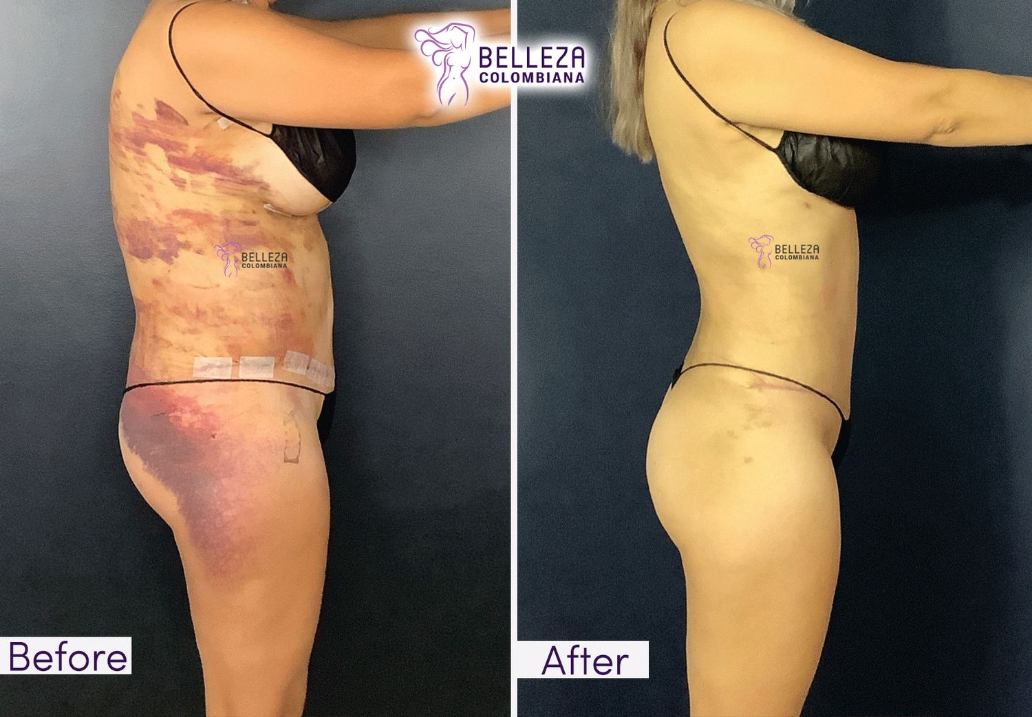 Post Op Before & After