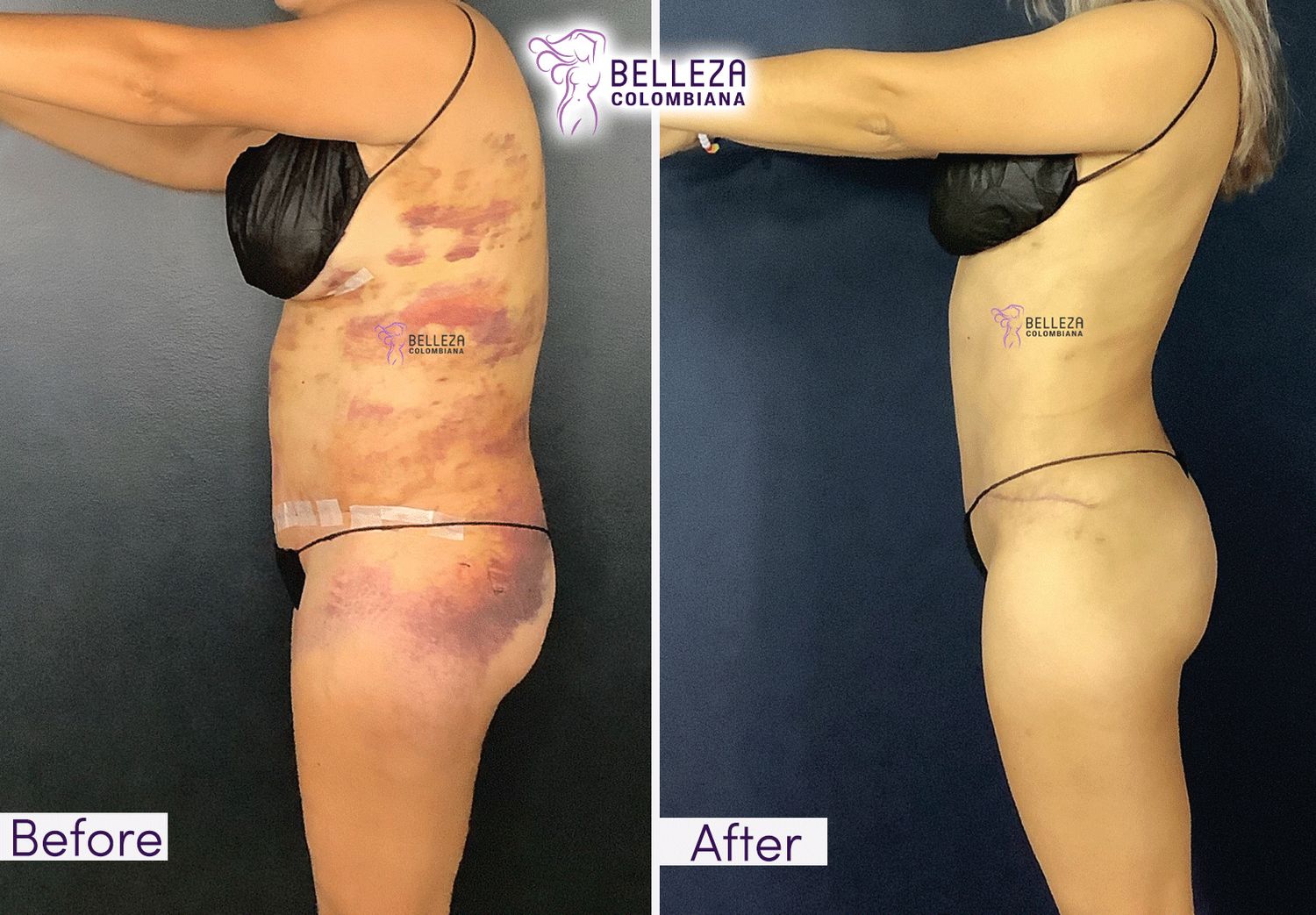 Post Op Before & After