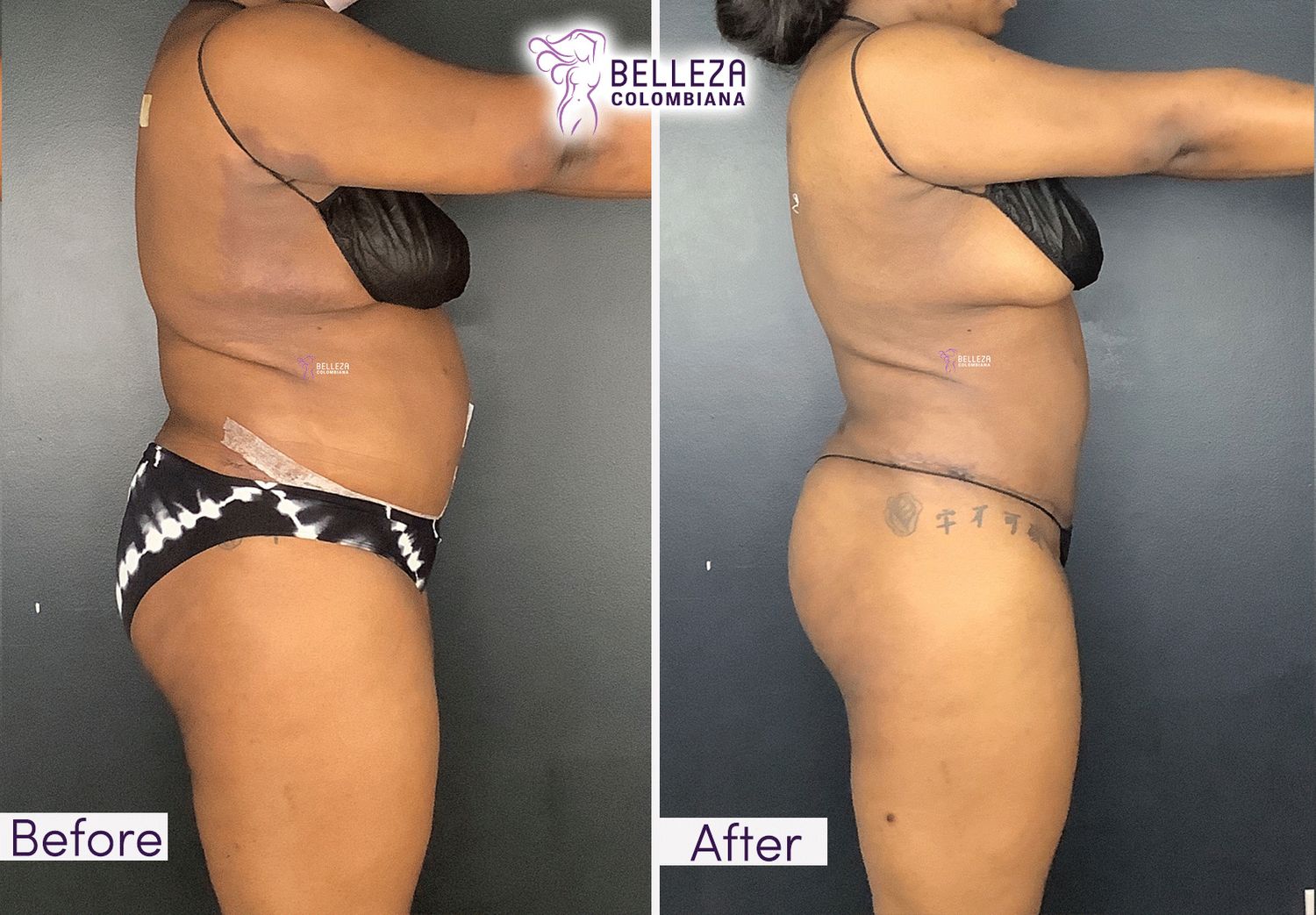 Post Op Before & After