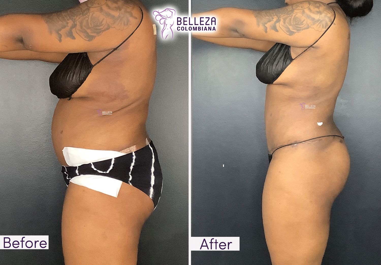 Post Op Before & After