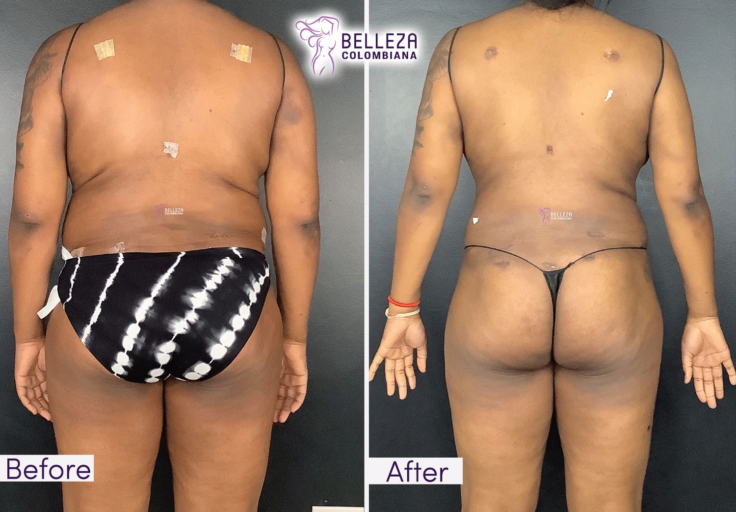 Post Op Before & After