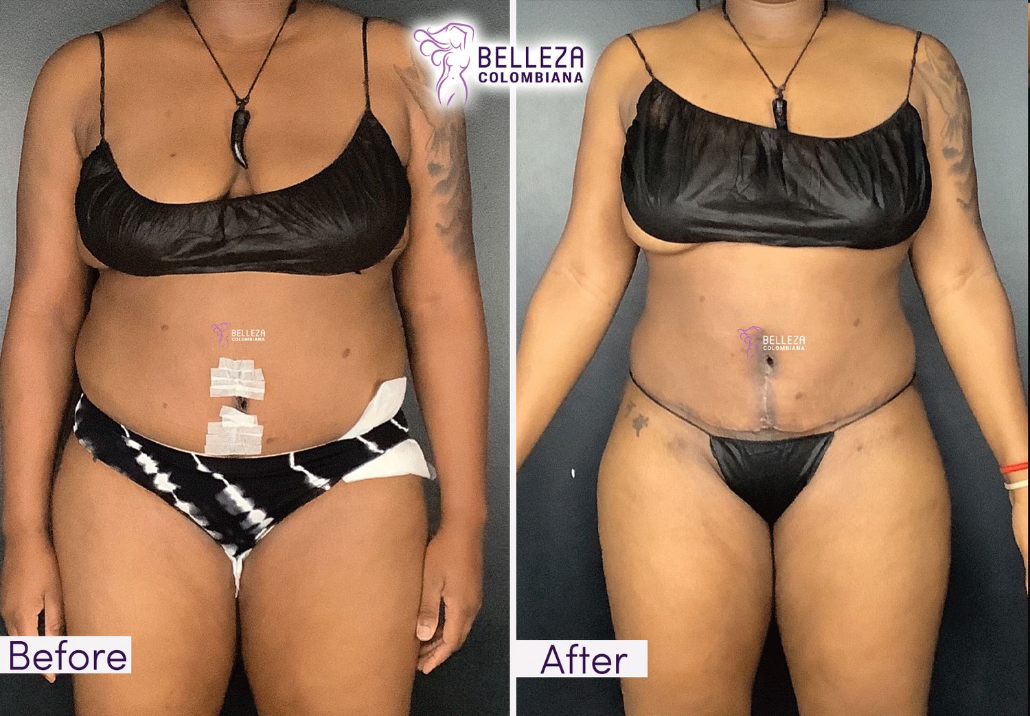 Post Op Before & After