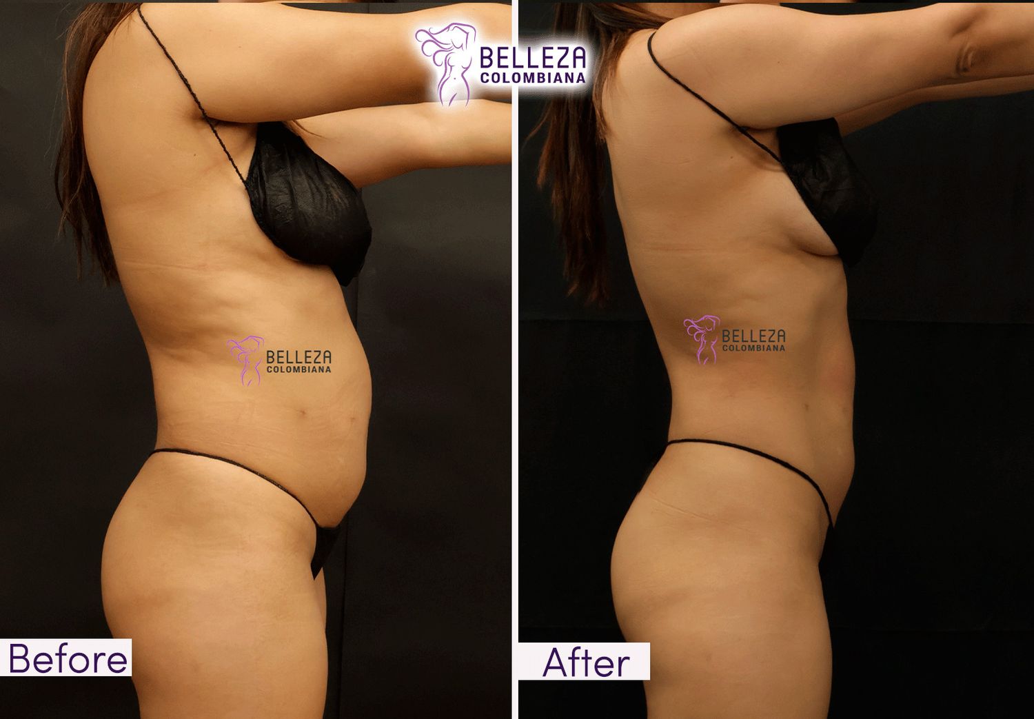 Post Op Before & After