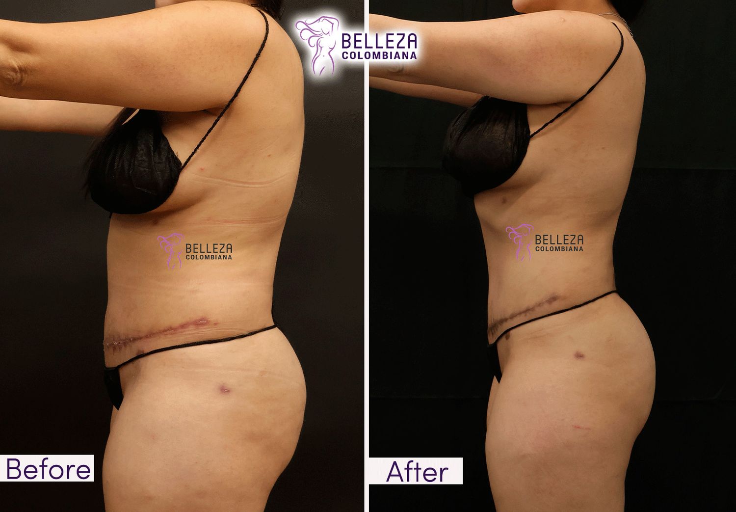 Post Op Before & After