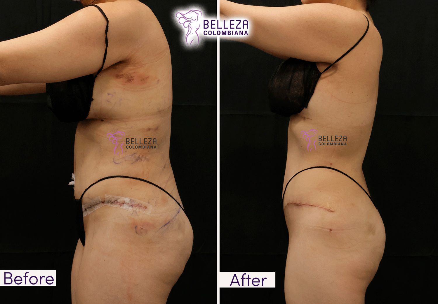 Post Op Before & After