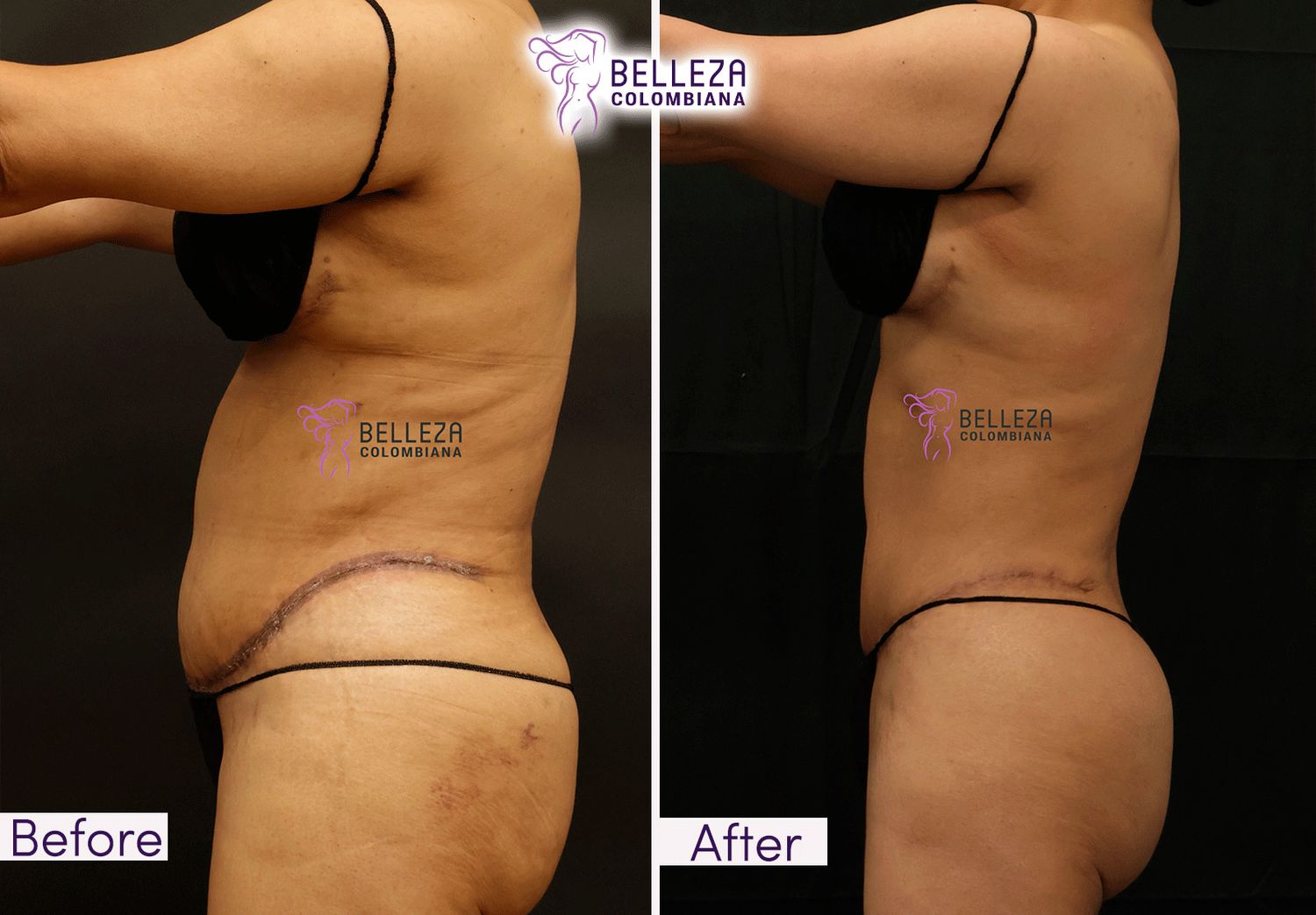 Post Op Before & After