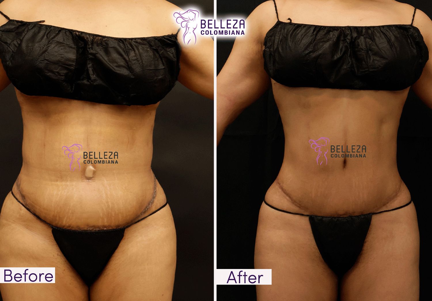 Post Op Before & After