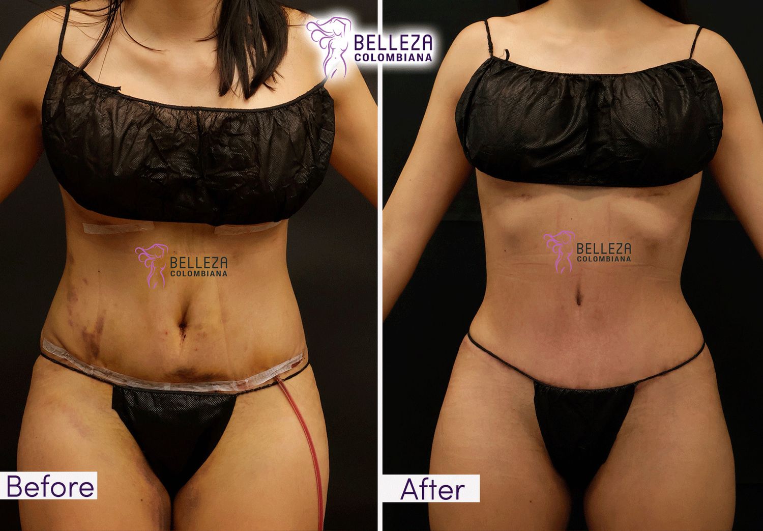 Post Op Before & After