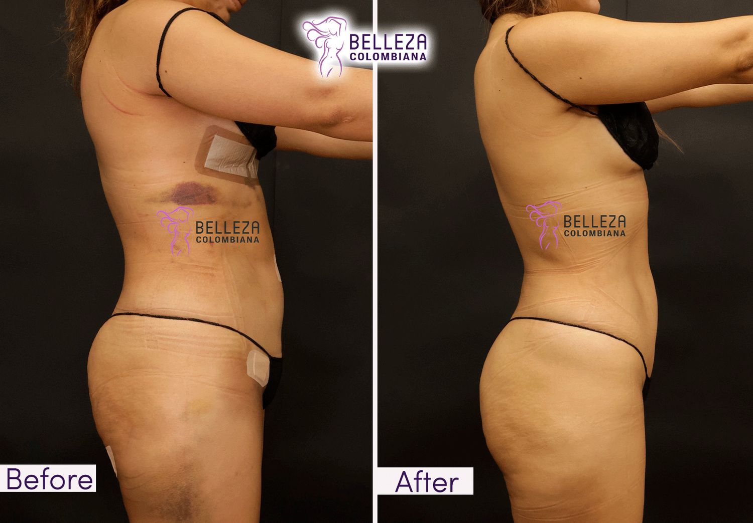 Post Op Before & After