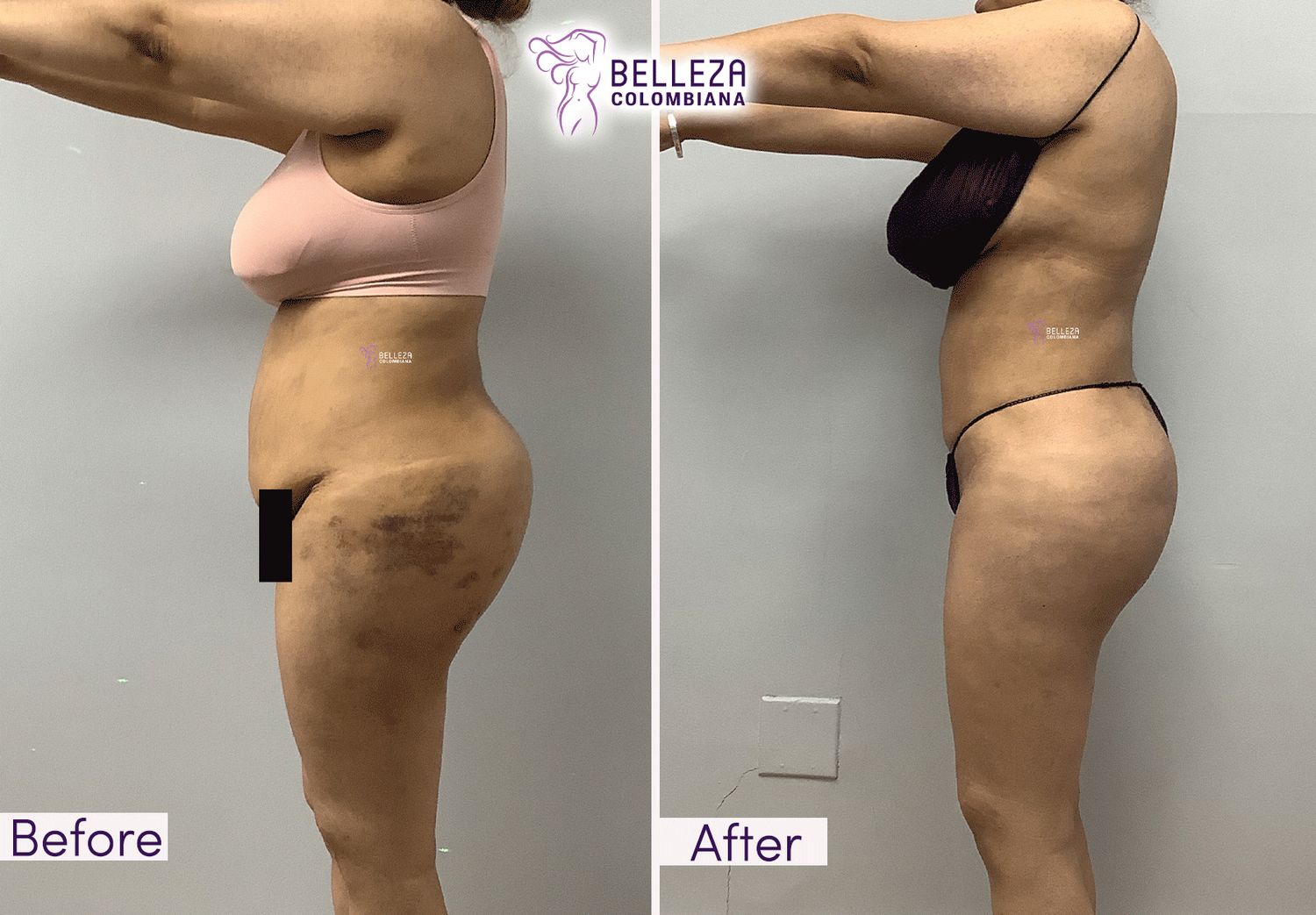 Post Op Before & After