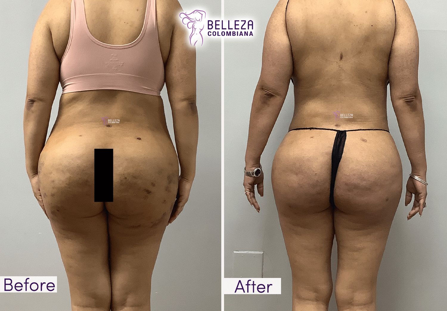 Post Op Before & After