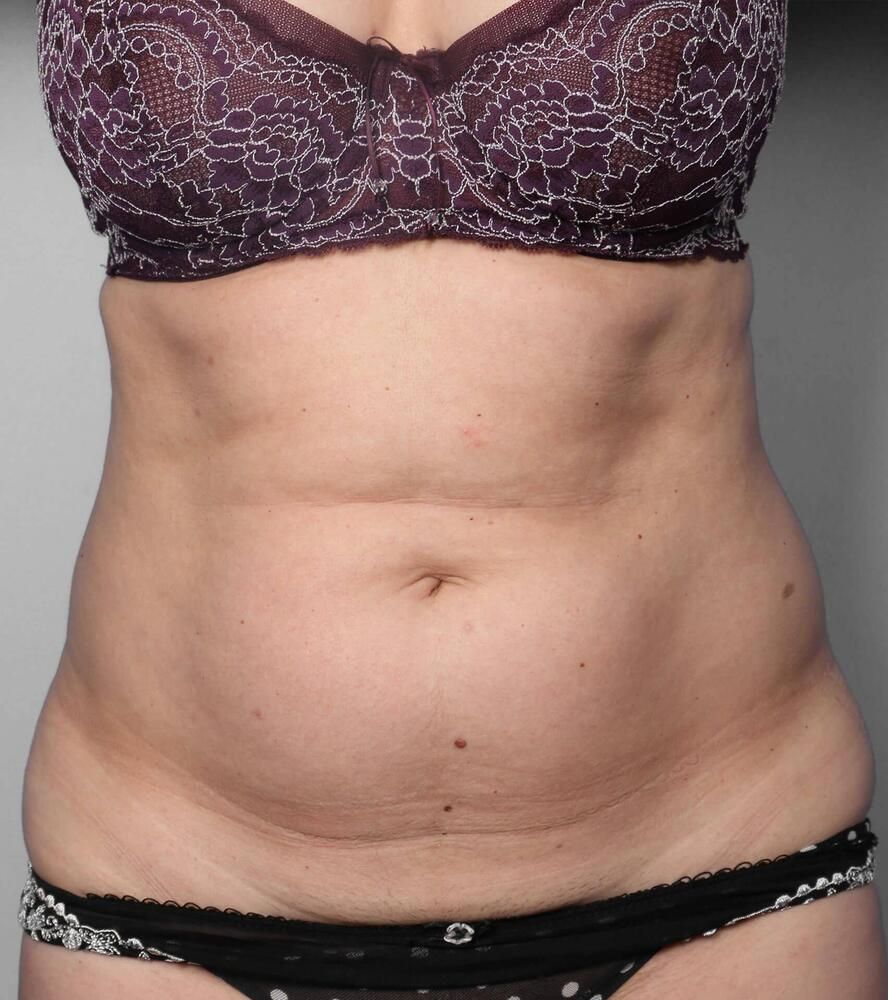 Liposuction Before & After