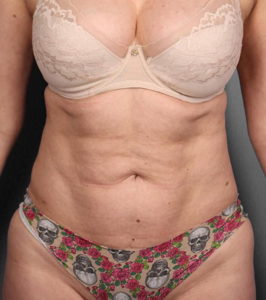 Liposuction Before & After