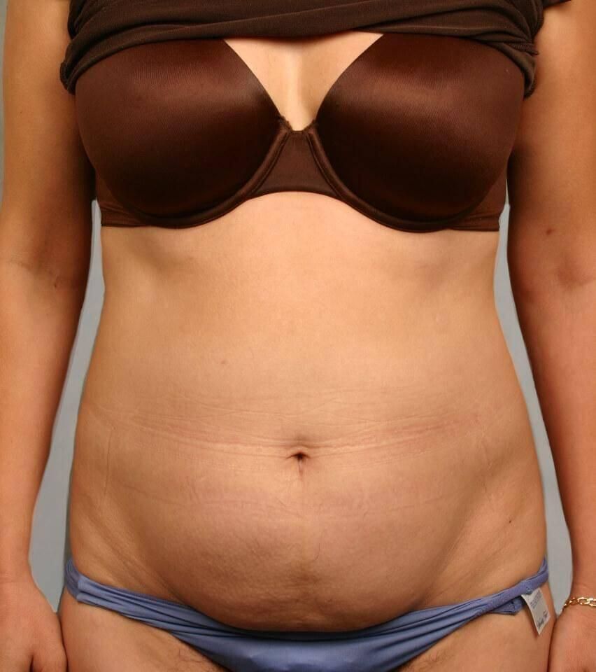Liposuction Before & After