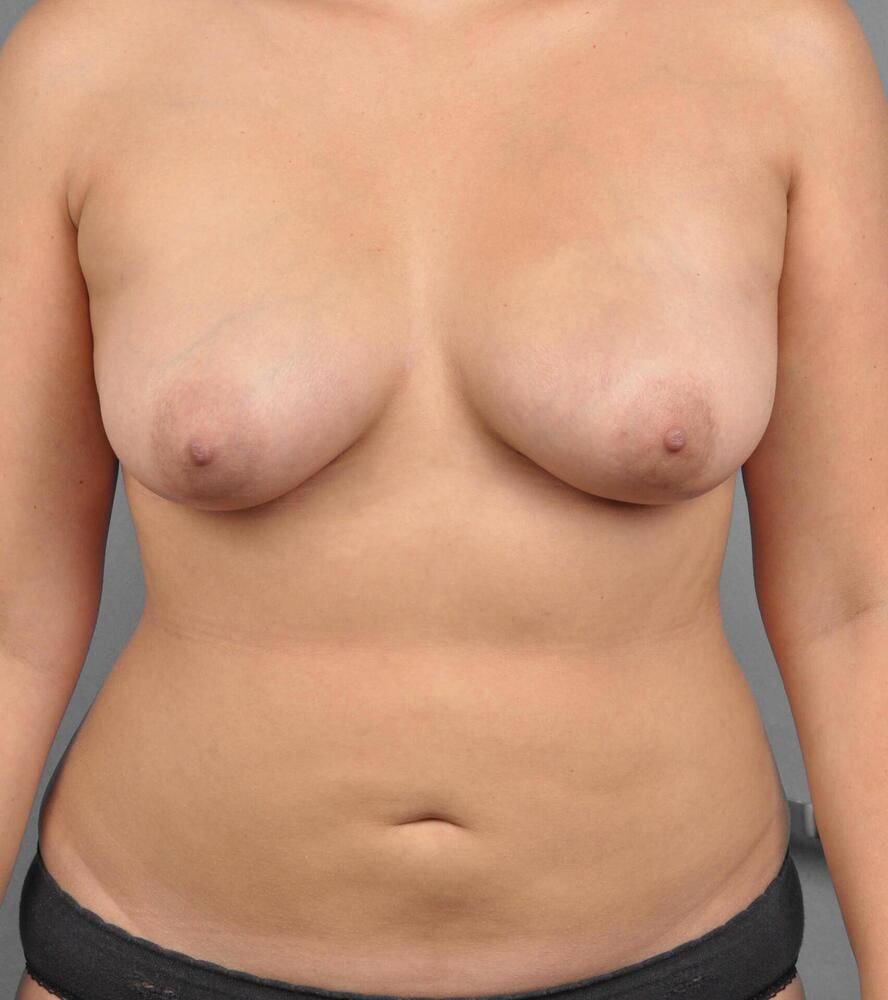 Liposuction Before & After