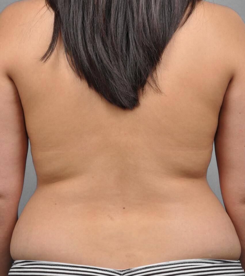 Liposuction Before & After